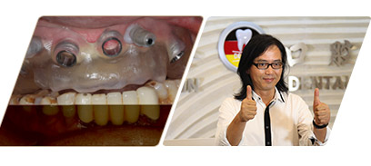 數字化種植牙介紹